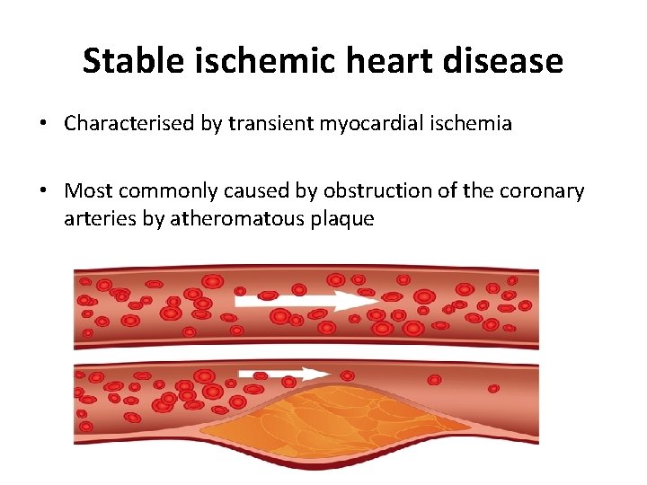 Stable ischemic heart disease • Characterised by transient myocardial ischemia • Most commonly caused