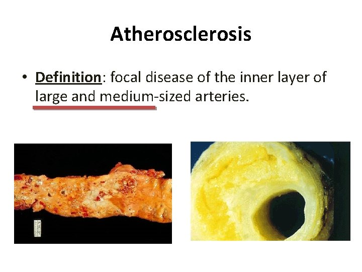 Atherosclerosis • Definition: focal disease of the inner layer of large and medium-sized arteries.