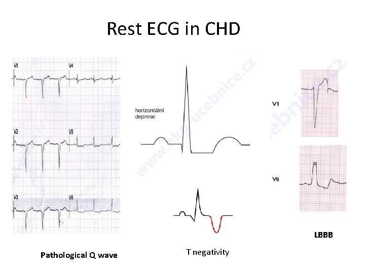 Rest ECG in CHD LBBB Pathological Q wave T negativity 