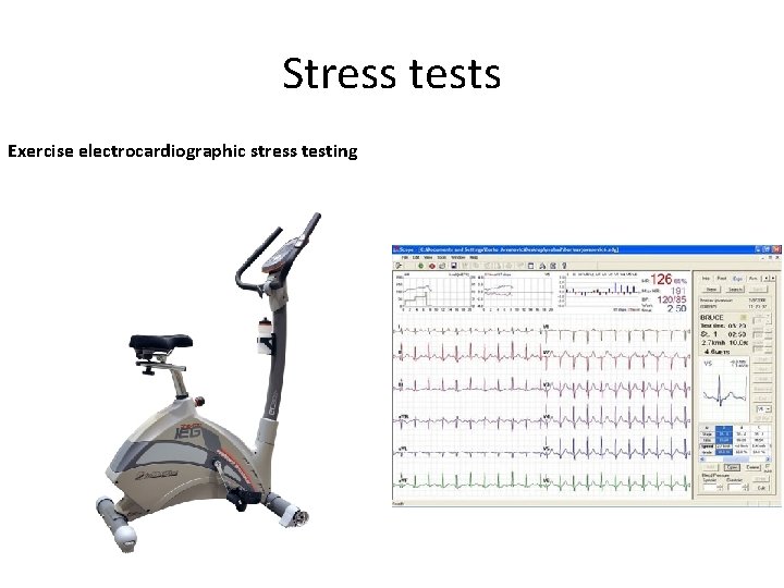 Stress tests Exercise electrocardiographic stress testing 