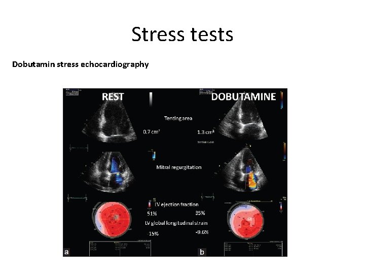 Stress tests Dobutamin stress echocardiography 