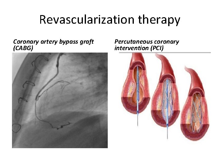 Revascularization therapy Coronary artery bypass graft (CABG) Percutaneous coronary intervention (PCI) 