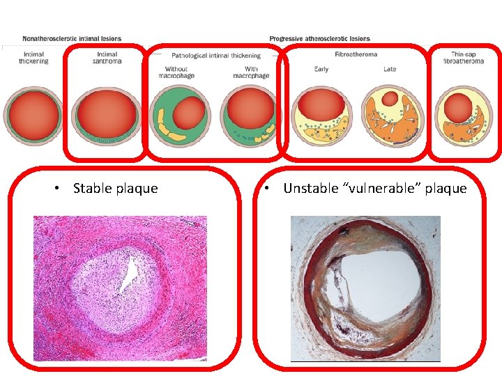  • Stable plaque • Unstable “vulnerable” plaque 