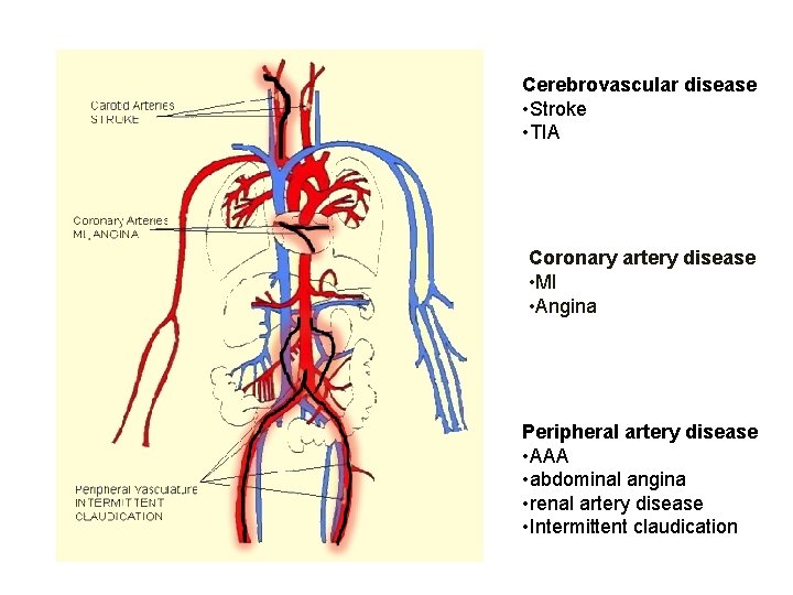 Cerebrovascular disease • Stroke • TIA Coronary artery disease • MI • Angina Peripheral