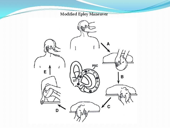 Modified Epley Maneuver 