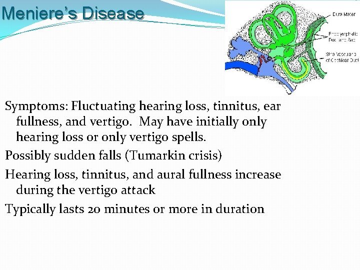 Meniere’s Disease Symptoms: Fluctuating hearing loss, tinnitus, ear fullness, and vertigo. May have initially