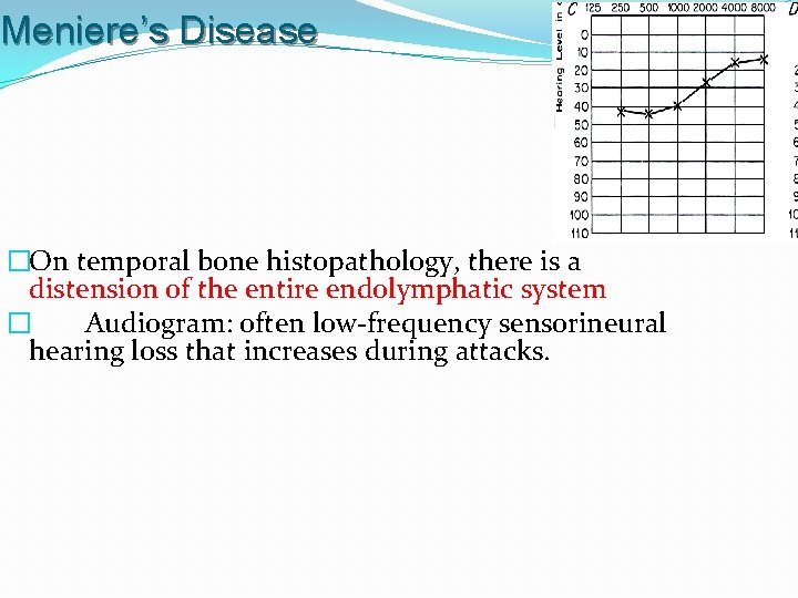 Meniere’s Disease �On temporal bone histopathology, there is a distension of the entire endolymphatic