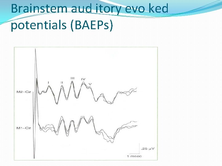 Brainstem aud itory evo ked potentials (BAEPs) 