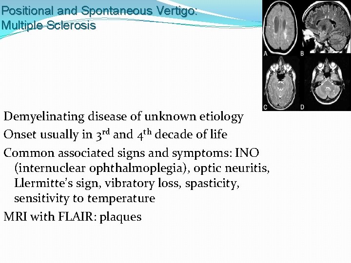 Positional and Spontaneous Vertigo: Multiple Sclerosis Demyelinating disease of unknown etiology Onset usually in