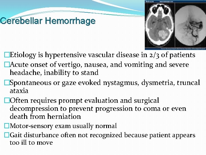 Cerebellar Hemorrhage �Etiology is hypertensive vascular disease in 2/3 of patients �Acute onset of