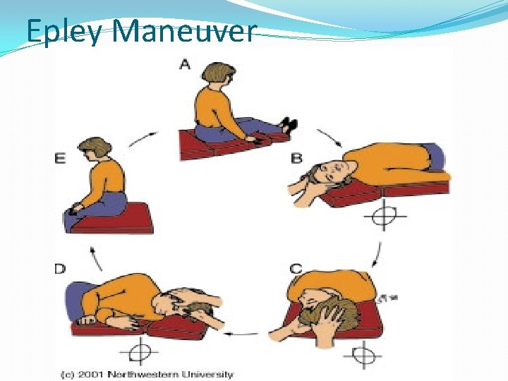 Epley Maneuver 