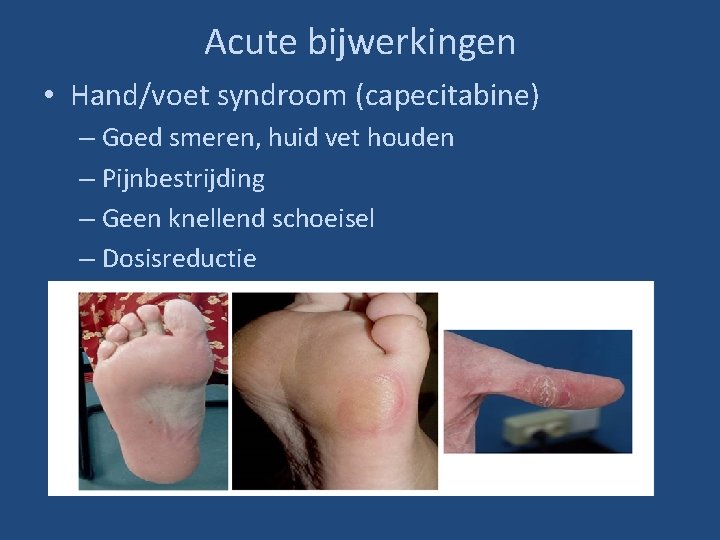 Acute bijwerkingen • Hand/voet syndroom (capecitabine) – Goed smeren, huid vet houden – Pijnbestrijding