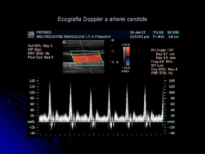 Ecografia Doppler a arterei carotide 