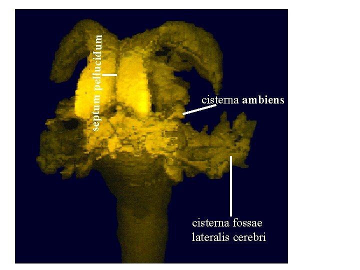 septum pellucidum cisterna ambiens cisterna fossae lateralis cerebri septum pellucidum cisterna ambiens cisterna fossae lateralis cerebri