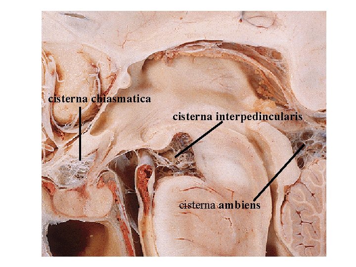 cisterna chiasmatica cisterna interpedincularis cisterna ambiens cisterna chiasmatica cisterna interpedincularis cisterna ambiens
