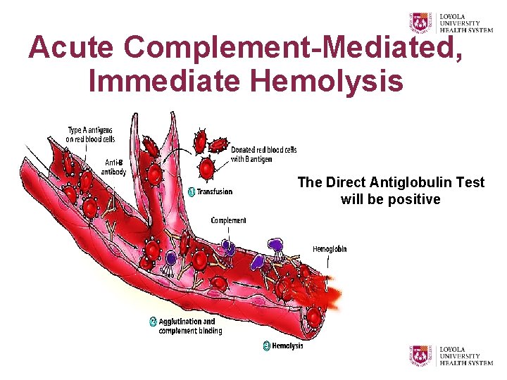 Acute Complement-Mediated, Immediate Hemolysis The Direct Antiglobulin Test will be positive 