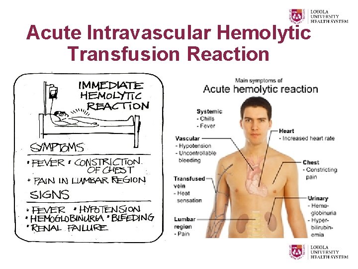 Acute Intravascular Hemolytic Transfusion Reaction 