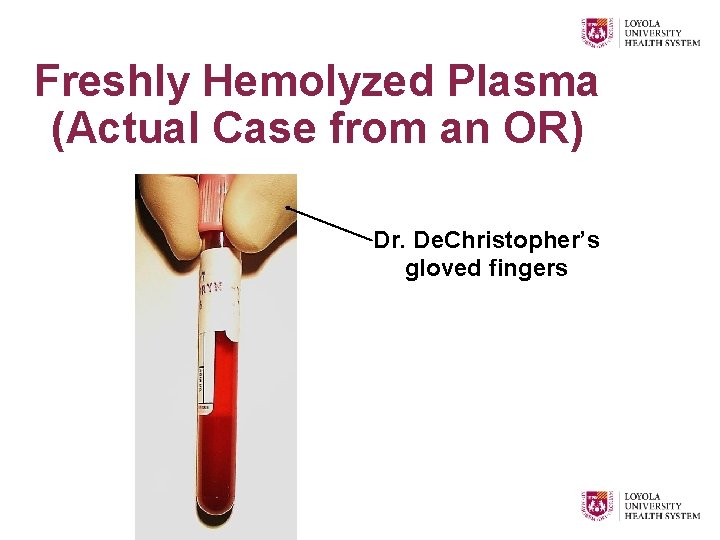 Freshly Hemolyzed Plasma (Actual Case from an OR) Dr. De. Christopher’s gloved fingers 