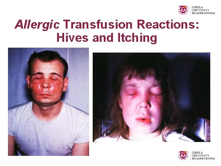 Allergic Transfusion Reactions: Hives and Itching 