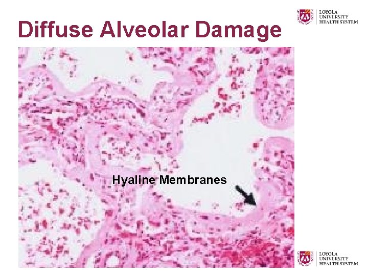 Diffuse Alveolar Damage Hyaline Membranes 