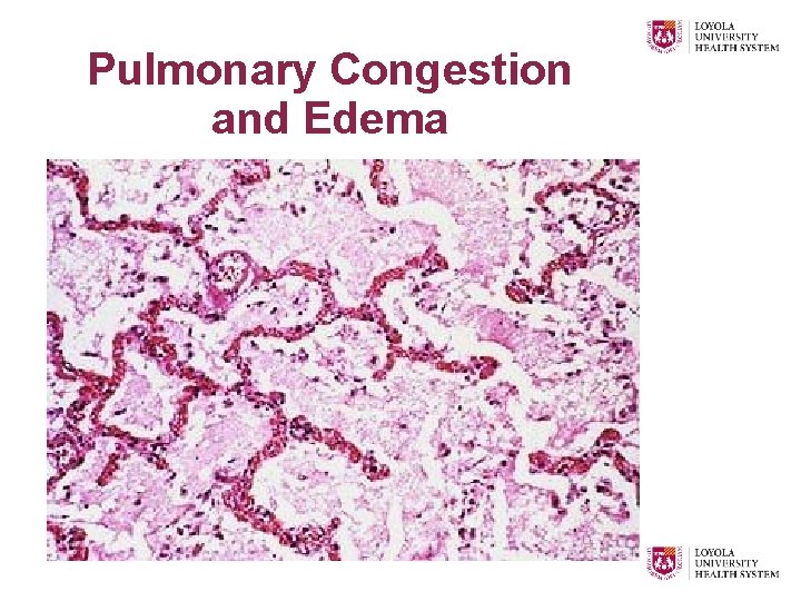 Pulmonary Congestion and Edema 