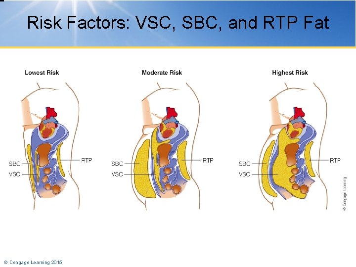 Risk Factors: VSC, SBC, and RTP Fat © Cengage Learning 2015 
