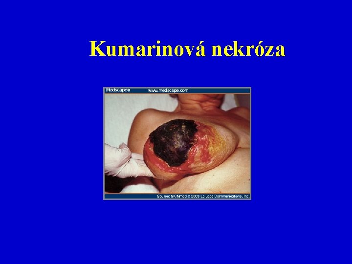 Kumarinová nekróza 