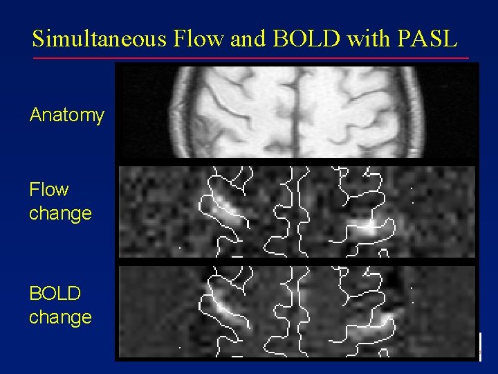 Simultaneous Flow and BOLD with PASL Anatomy Flow change BOLD change 