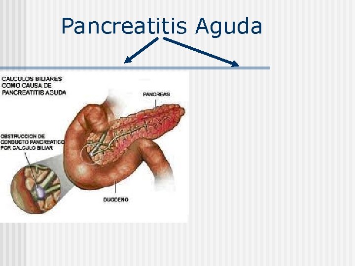  Pancreatitis Aguda 