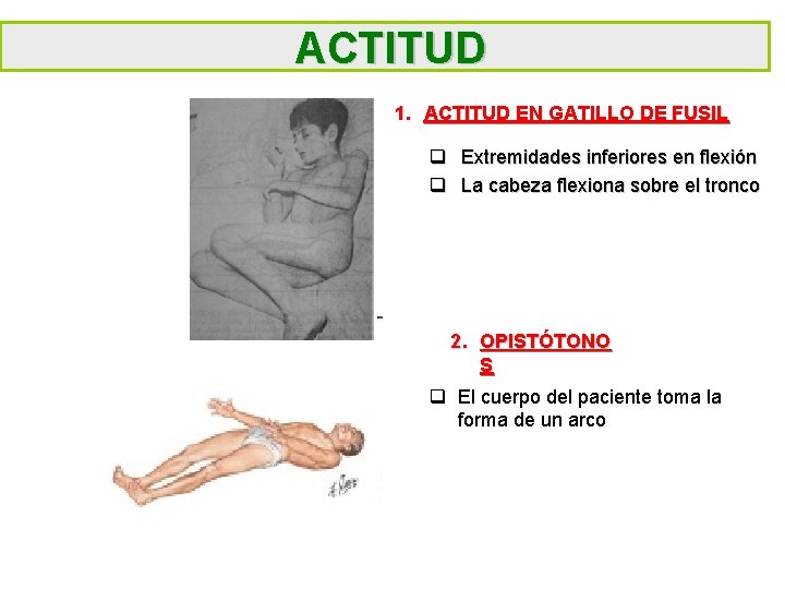 ACTITUD 1. ACTITUD EN GATILLO DE FUSIL q Extremidades inferiores en flexión q La