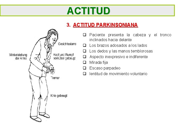 ACTITUD 3. ACTITUD PARKINSONIANA q Paciente presenta la cabeza y el tronco inclinados hacia