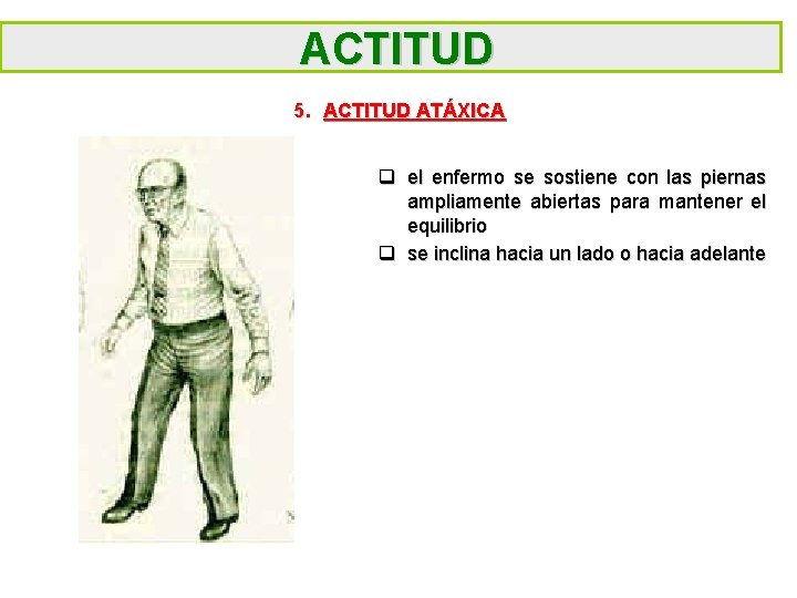 ACTITUD 5. ACTITUD ATÁXICA q el enfermo se sostiene con las piernas ampliamente abiertas