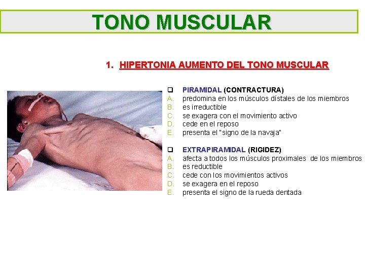 TONO MUSCULAR 1. HIPERTONIA AUMENTO DEL TONO MUSCULAR q A. B. C. D. E.