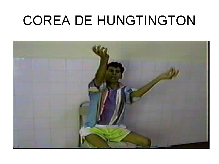 COREA DE HUNGTINGTON 