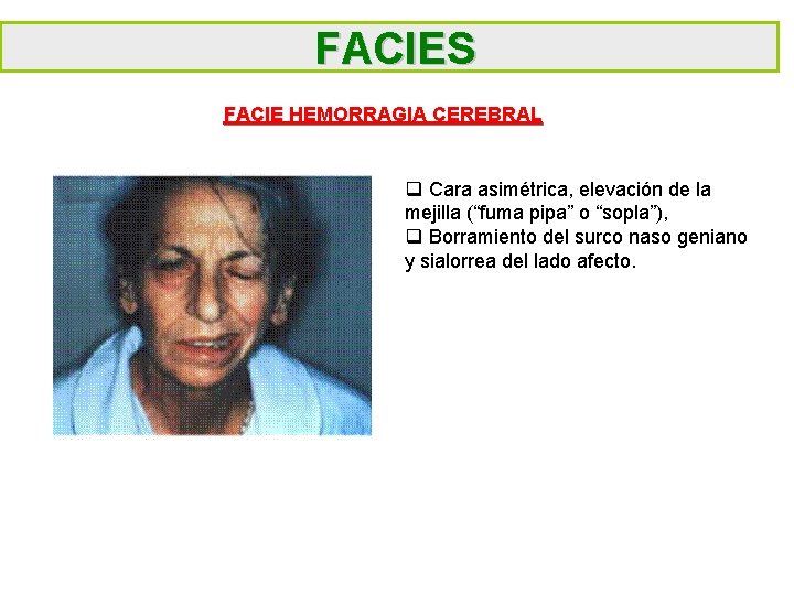 FACIES FACIE HEMORRAGIA CEREBRAL q Cara asimétrica, elevación de la mejilla (“fuma pipa” o