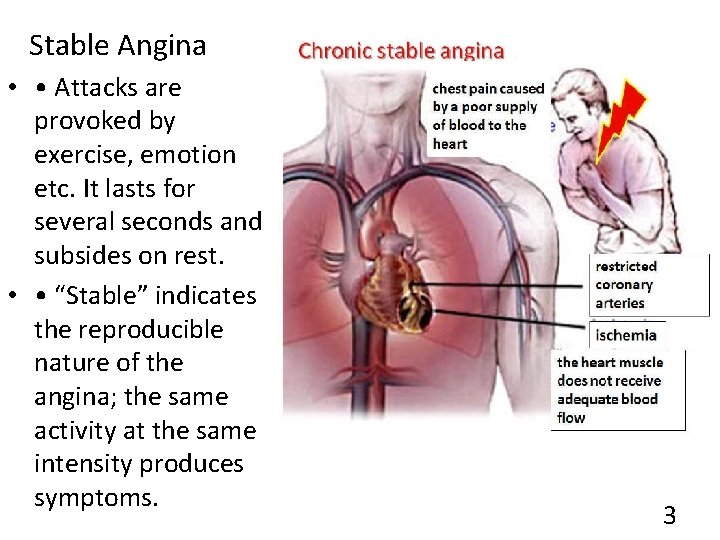 Stable Angina • • Attacks are provoked by exercise, emotion etc. It lasts for