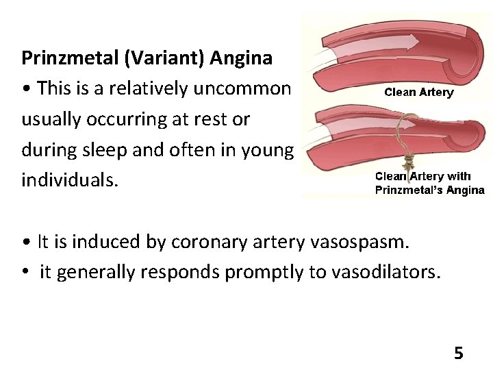 Prinzmetal (Variant) Angina • This is a relatively uncommon usually occurring at rest or