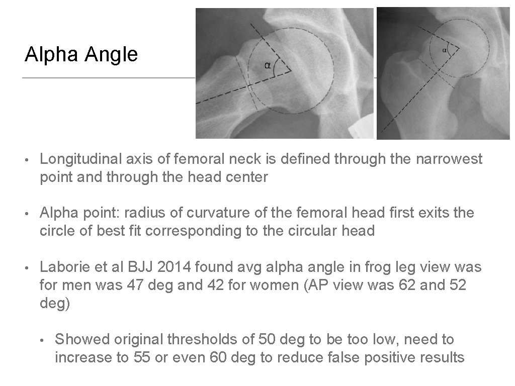 Alpha Angle • Longitudinal axis of femoral neck is defined through the narrowest point