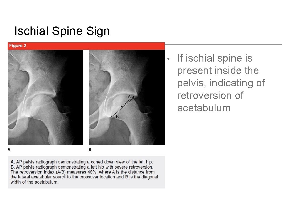 Ischial Spine Sign • If ischial spine is present inside the pelvis, indicating of