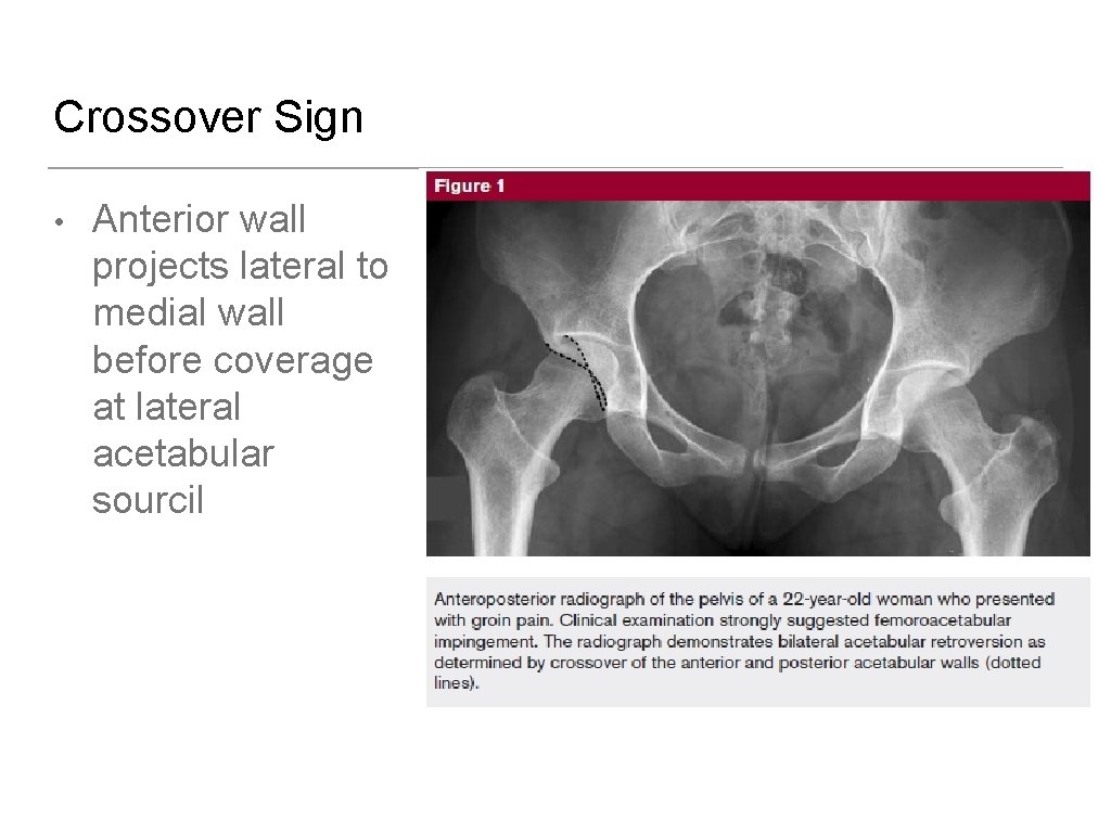Crossover Sign • Anterior wall projects lateral to medial wall before coverage at lateral