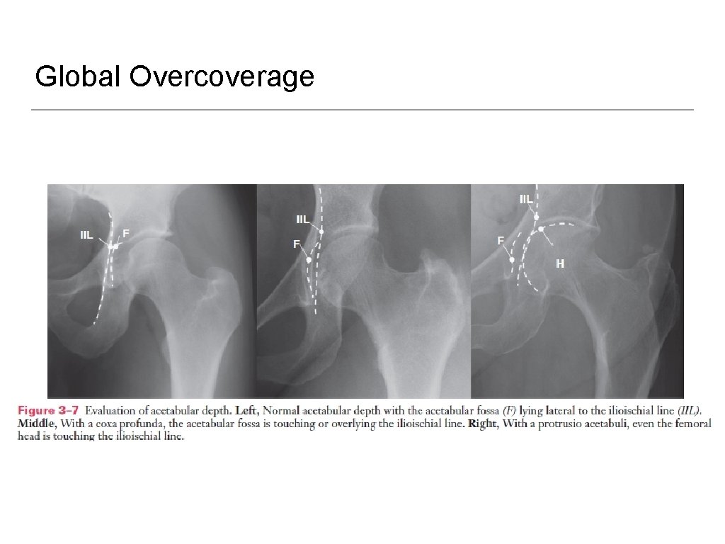 Global Overcoverage 