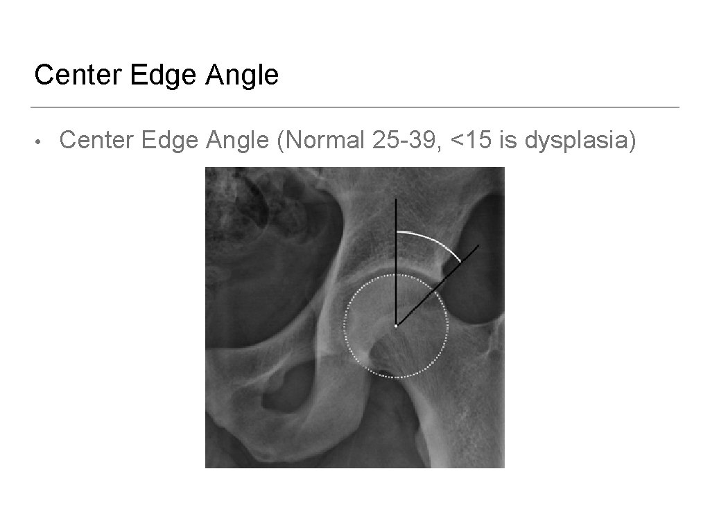 Center Edge Angle • Center Edge Angle (Normal 25 -39, <15 is dysplasia) 