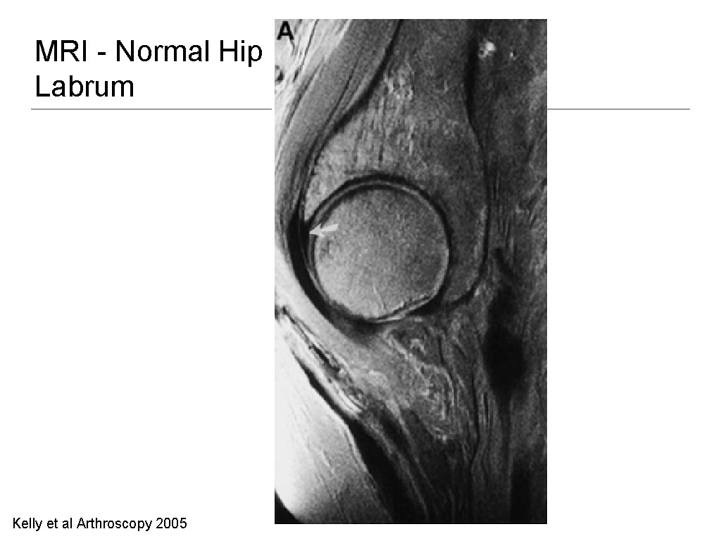 MRI - Normal Hip Labrum Kelly et al Arthroscopy 2005 