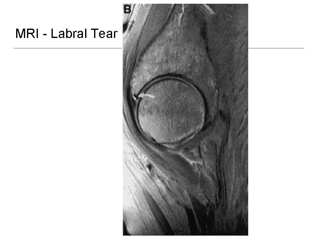 MRI - Labral Tear 