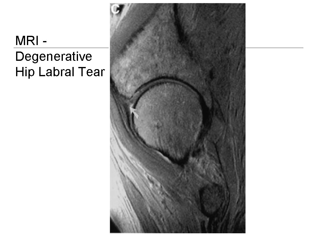 MRI Degenerative Hip Labral Tear 
