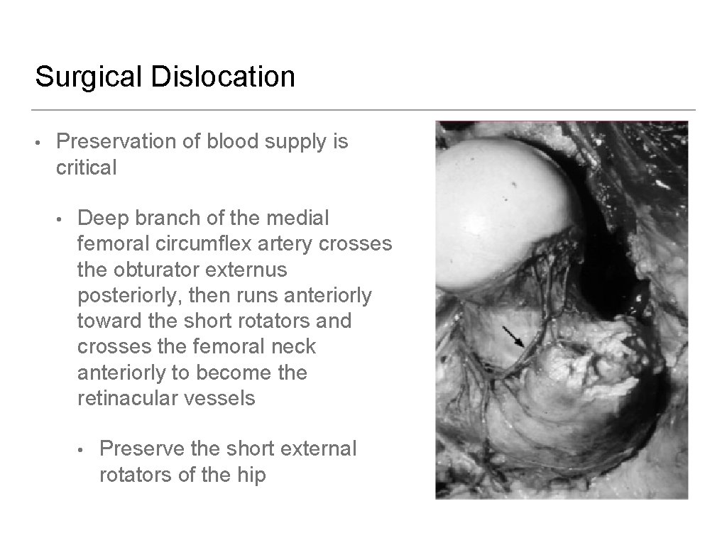 Surgical Dislocation • Preservation of blood supply is critical • Deep branch of the