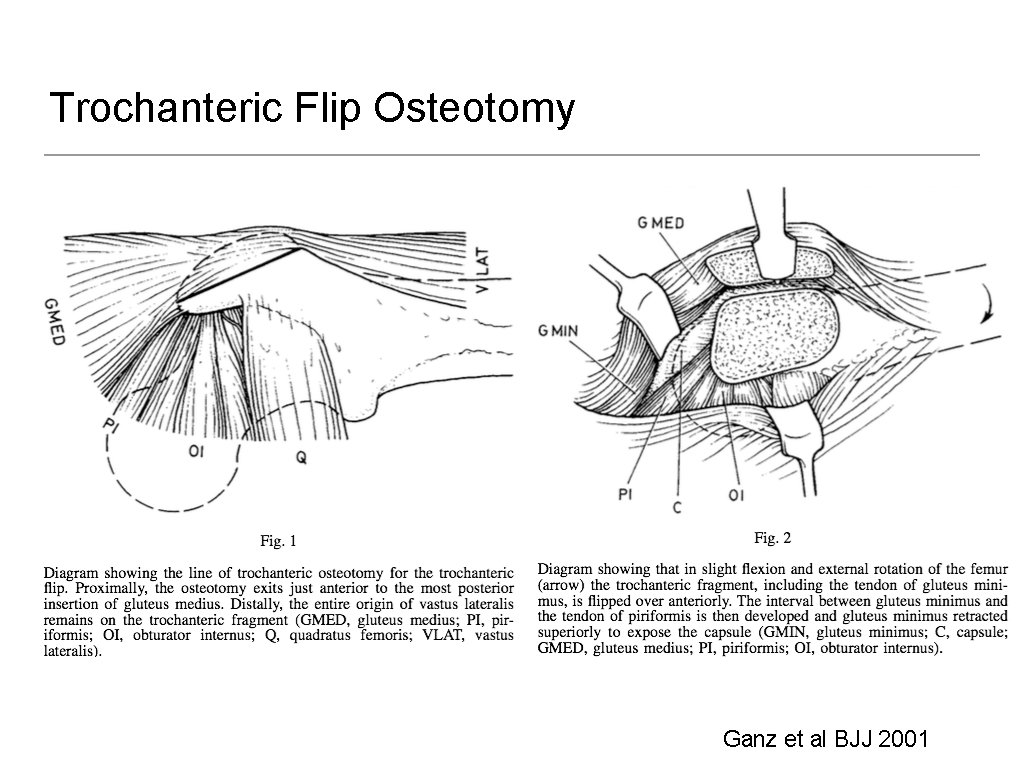 Trochanteric Flip Osteotomy Ganz et al BJJ 2001 