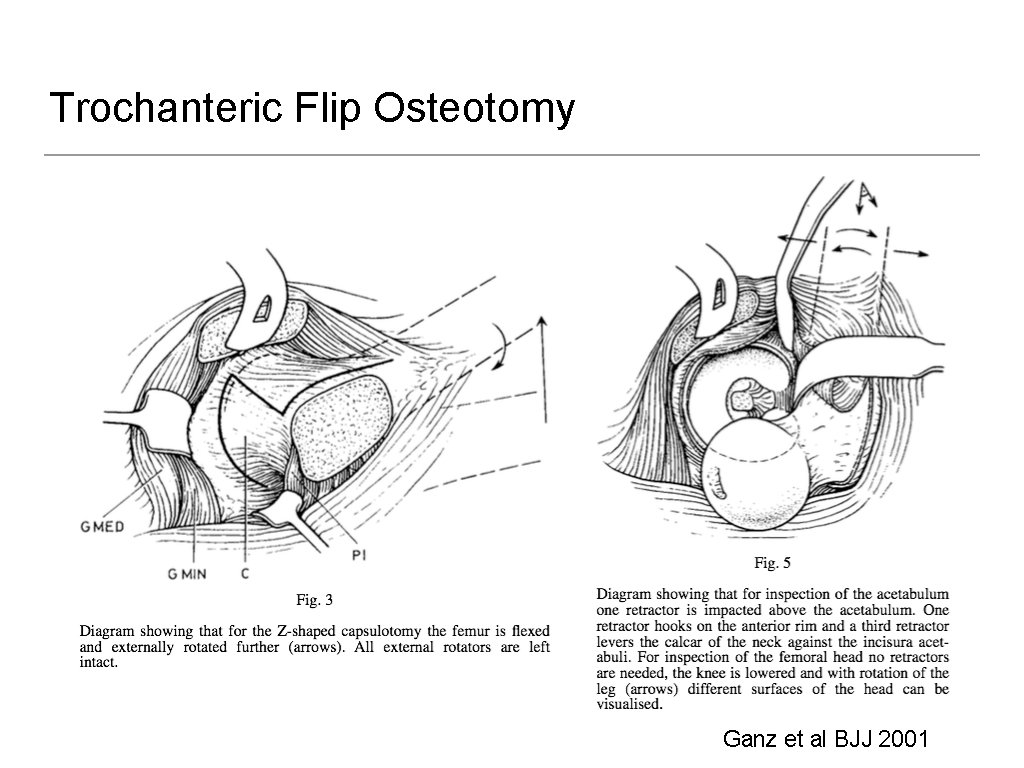 Trochanteric Flip Osteotomy Ganz et al BJJ 2001 