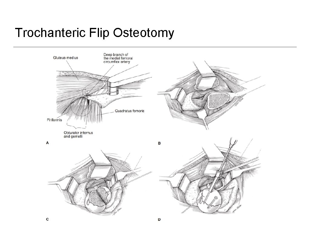 Trochanteric Flip Osteotomy 