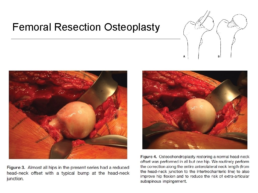 Femoral Resection Osteoplasty 